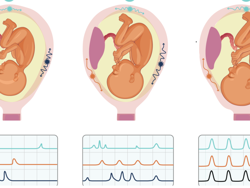 the-physiological-difference-between-braxton-hicks-and-labor-contractions